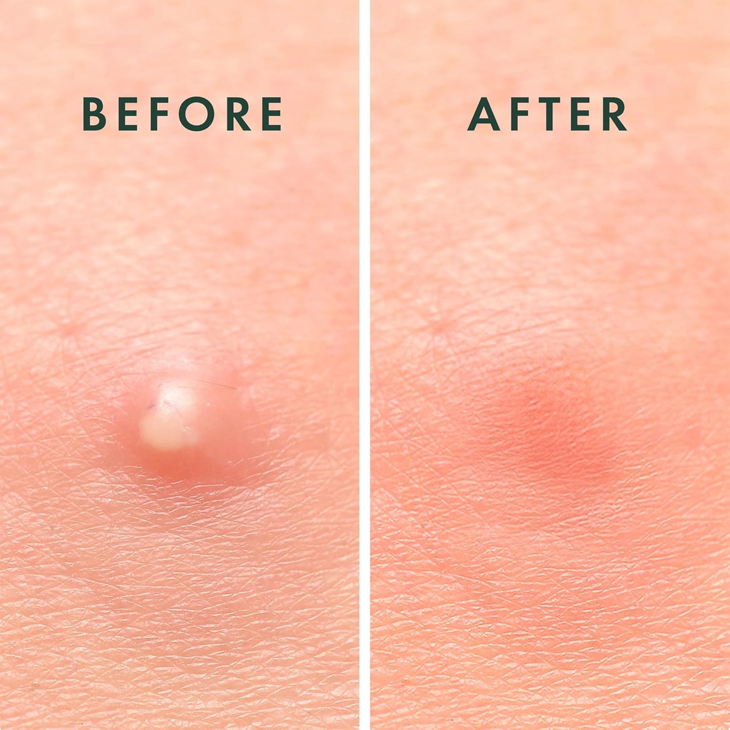 Rael Pimple Patches, Miracle Invisible Spot Cover - Hydrocolloid Acne Patch, Treatment for Breakouts, Absorbs Zits & Blemish, Korean Skin Care, 2 Sizes (24 Count)