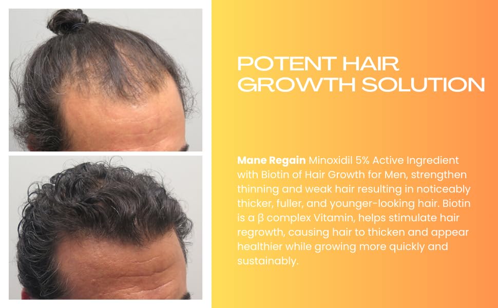 Minoxidil Topical Solution USP 5%, Extra Strength Hair Regrowth Treatment for Men, 3 Month Supply, Unscented, 6 Fl Oz (3 Pack)