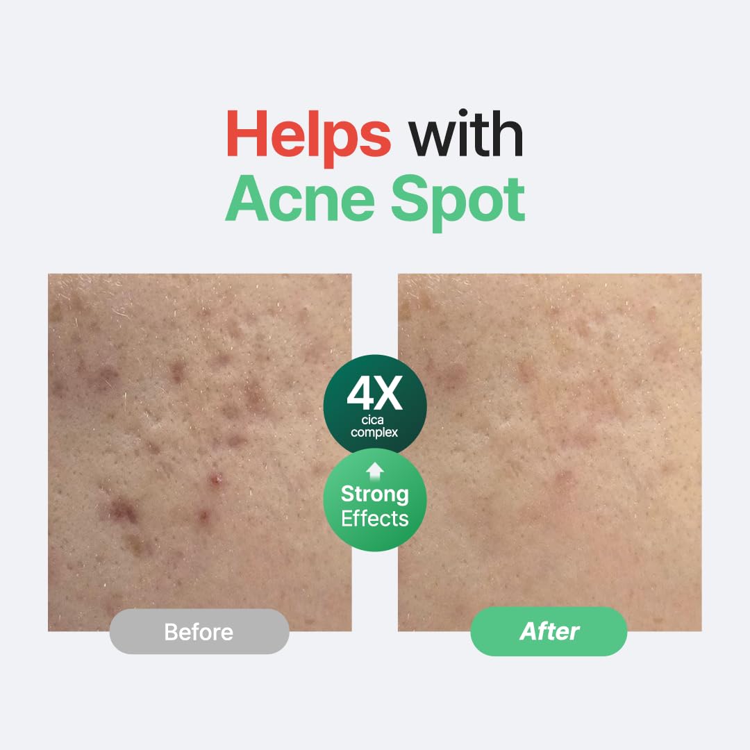 PURITO Centella Unscented Serum, 34,860 ppm Centella, Facial Serum for Sensitive Skin & Acne-Prone Skin, Soothing Serum, Vegan & Cruelty-Free, Korean Skincare, 2 fl.oz / 60ml