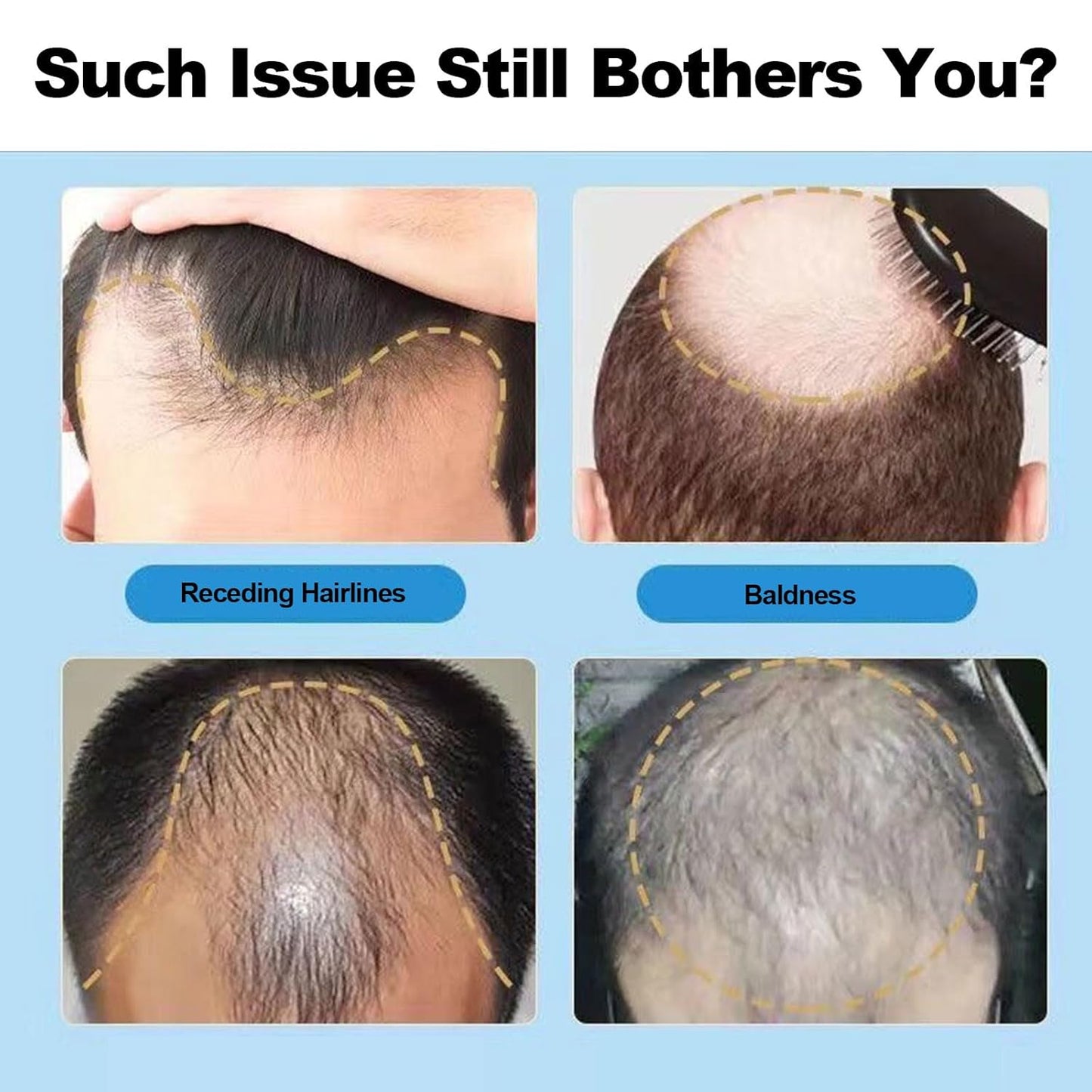 5% Minoxidil for Men, Beard Growth Kit, Hair Regrowth Serum for Hair Loss Treatment, Fuller & Thicker & Healthier Hair for Men & Women, with Massage Helper with Protective Cover