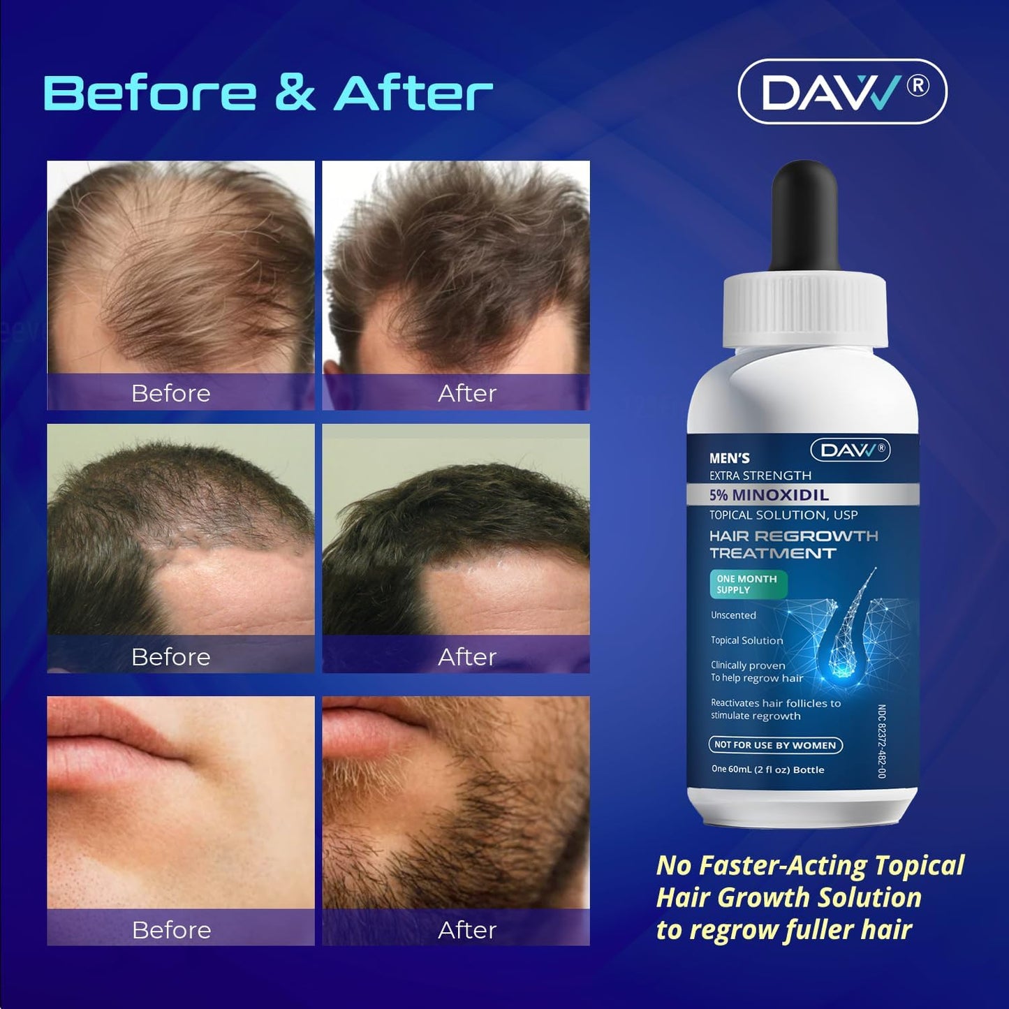 Minoxidil for Men Hair Growth Serum: Minoxidil 5 Percent - Hair Regrowth for Men - Minoxidil for Beard Growth - Hair Loss Treatments - Minoxidil 5% - Faster Thicker Stronger Hair Growth - 60ml