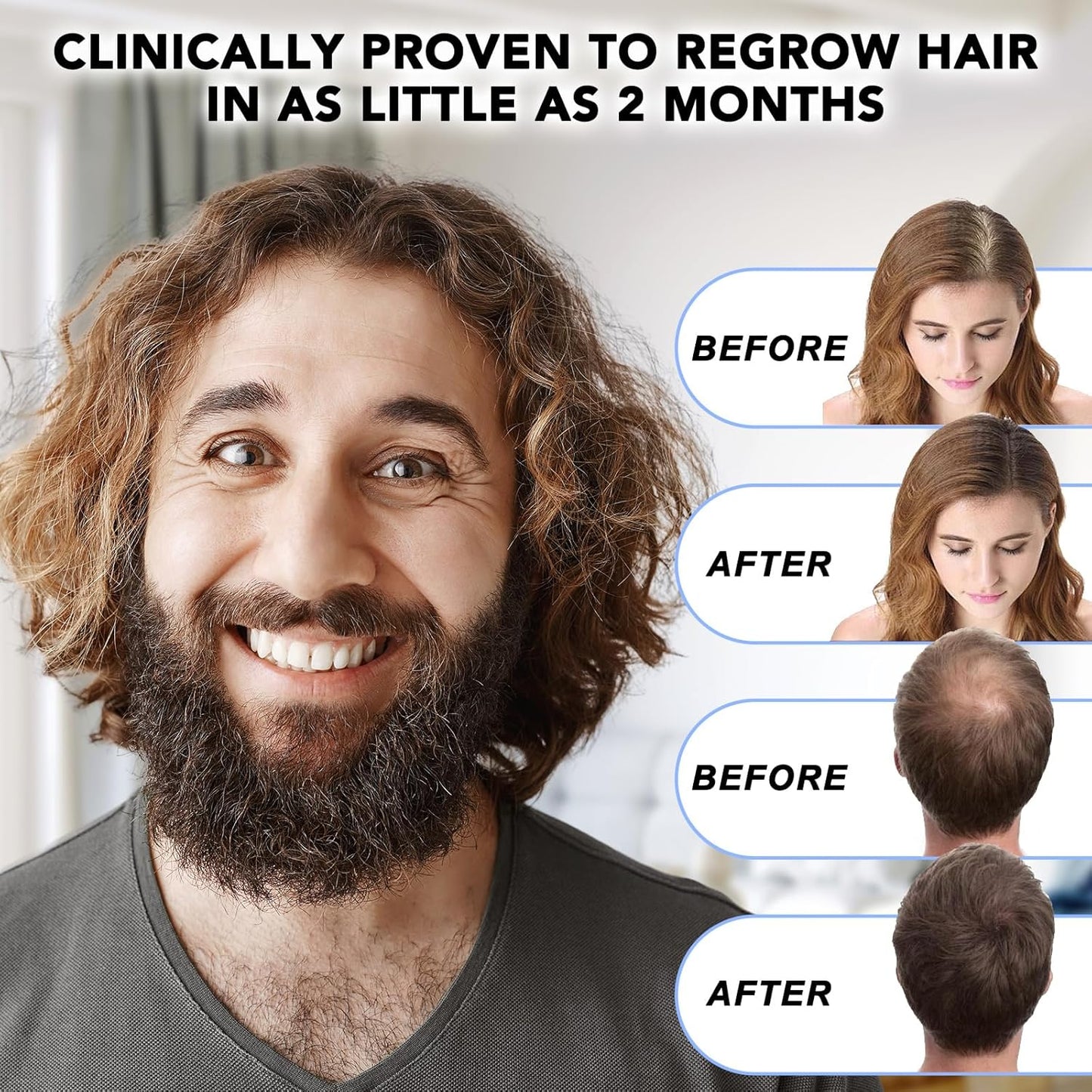 Minoxidil for Men-5% Extra Strength Hair Regrowth for Men Treatment-5% Topical Solution-Dropper Applicator Included -Minoxidil for Women-Stop Thinning & Hair Loss (1pcs