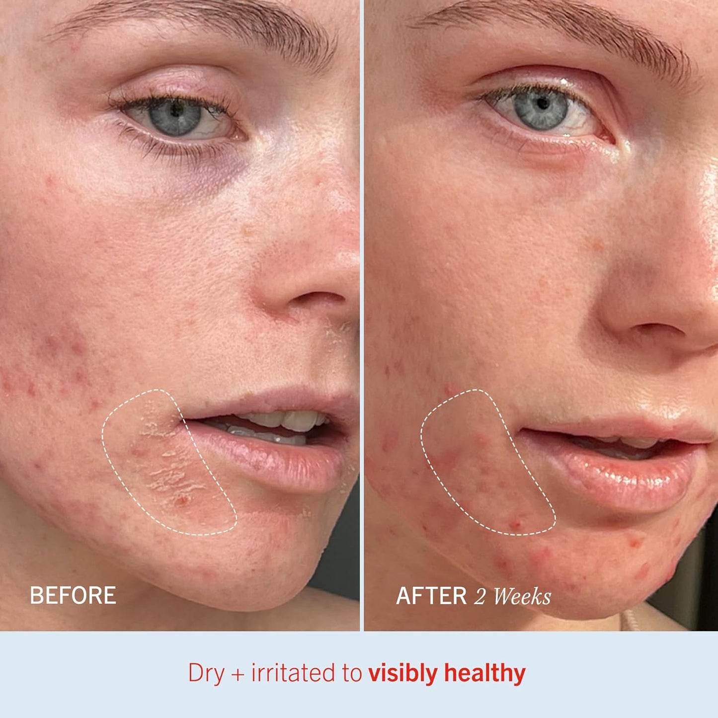 First Aid Beauty - Ultra Repair Cream, Intense Hydration Whipped Colloidal Oatmeal, Clinically Proven to Strengthen Skin Barrier in 7 Days & Helps Relieve Eczema, Luxury Face & Body Moisturizer, 2 oz