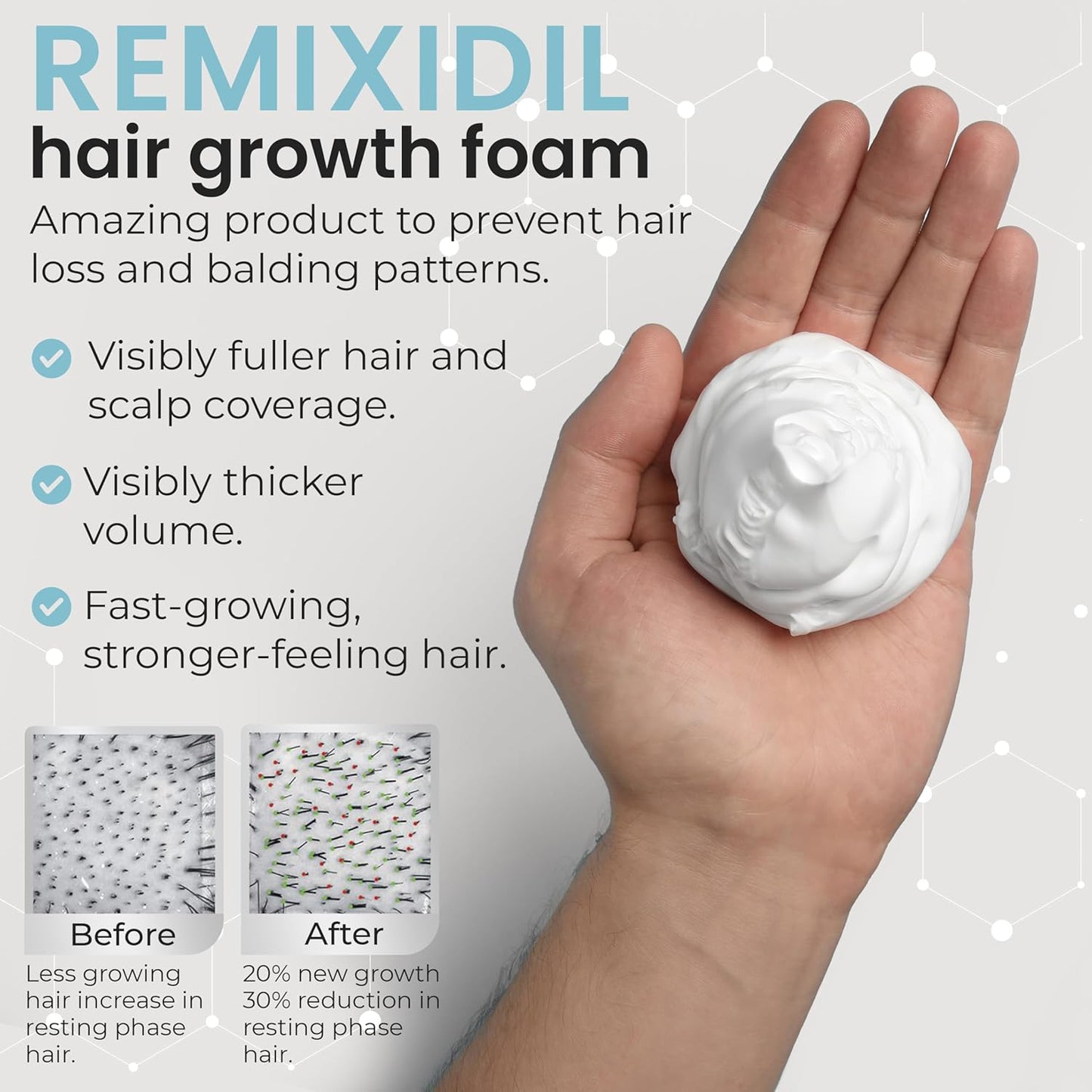Remixidil Men’s 5% Minoxidil Foam | Hair Regrowth Treatment for Men | Clinically Proven Formula for Hair Loss and Hair Growth | No Scalp Irritation | 3-Month Supply